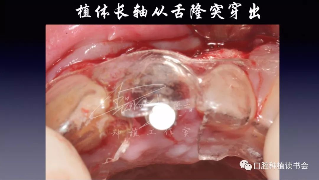 新春献礼种植牙生物学宽度的思考和临床应用中