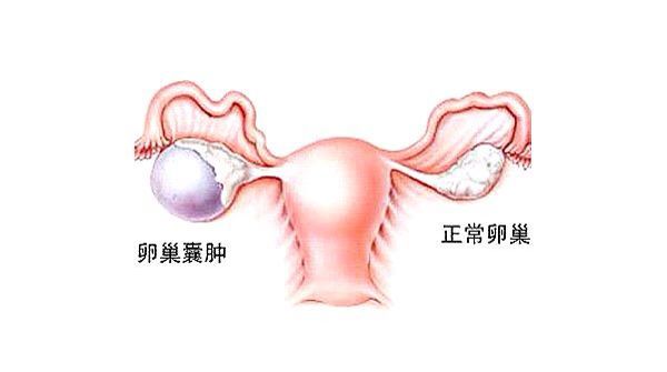 卵巢囊肿图片位置图片