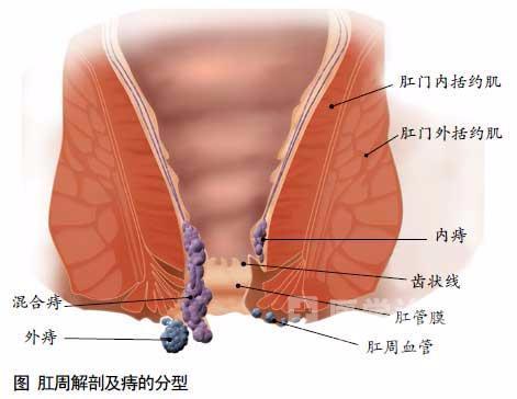 中医防痔特效方用它煮水喝,3天痔疮变小1周痊愈