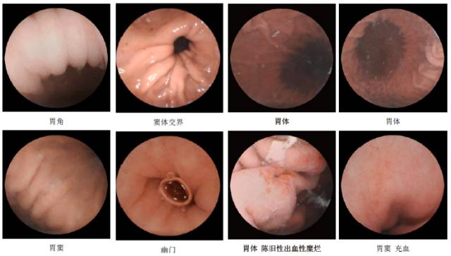 哈密美年大健康 胶囊胃镜