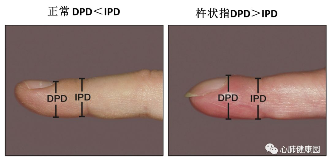 杵状指 早期 鉴别图片