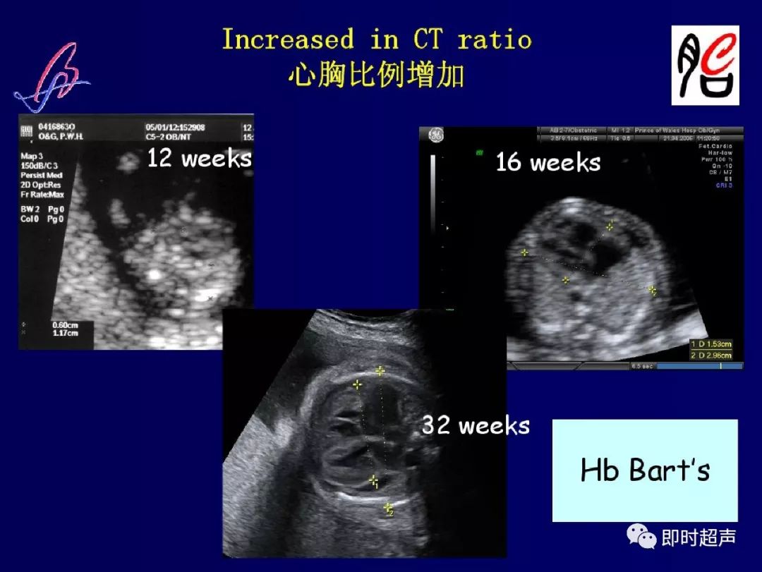 胎儿心脏的正常和异常超声解剖