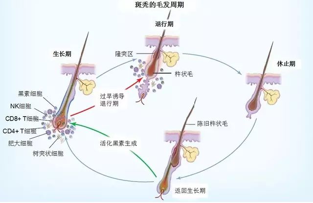 斑秃治疗方法图片