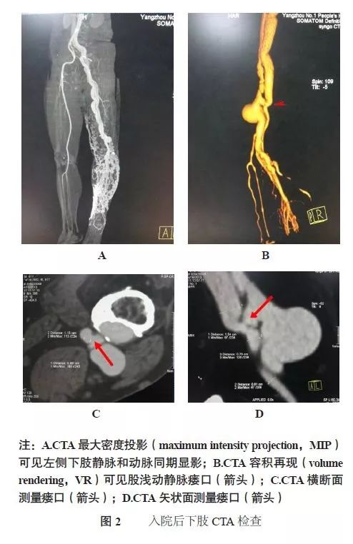 学术动态下肢动静脉瘘的介入治疗