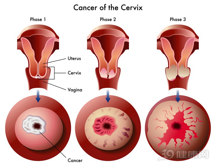 宫颈癌变的清晰图片图片