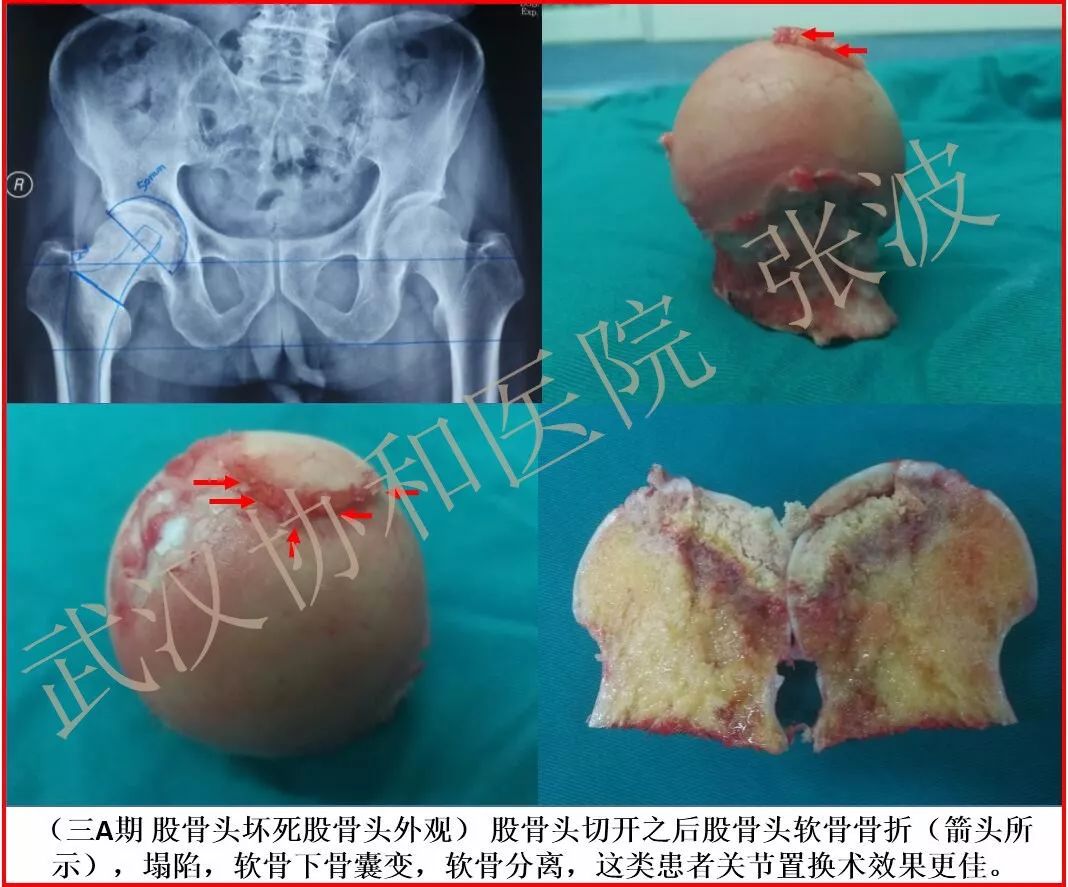 膽小慎入丨你確定這是壞死的股骨頭不是香菇