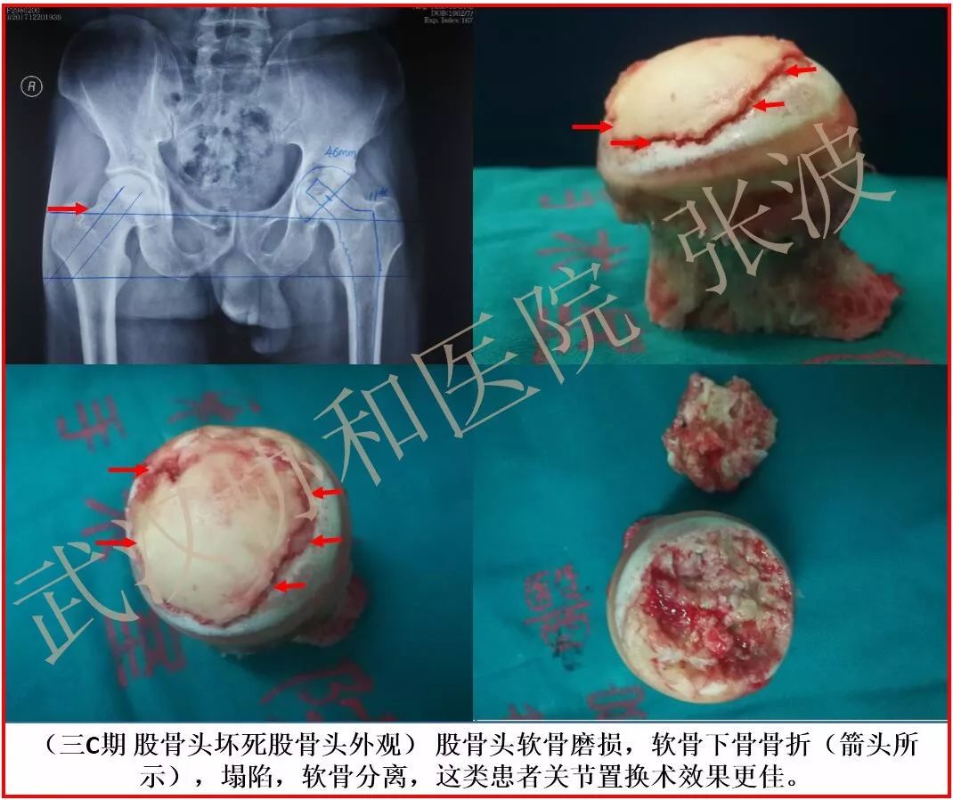 膽小慎入丨你確定這是壞死的股骨頭不是香菇