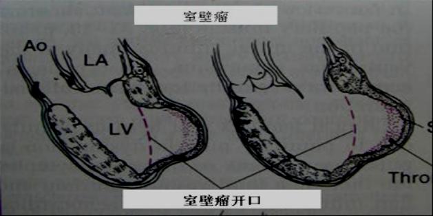 室壁瘤图解图片