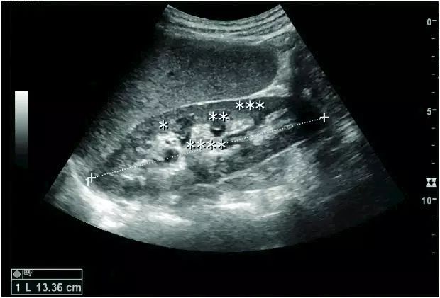 纵向扫描肾脏呈蚕豆型,右肾较左肾偏下;左侧肾脏因靠近脾脏可见单驼峰