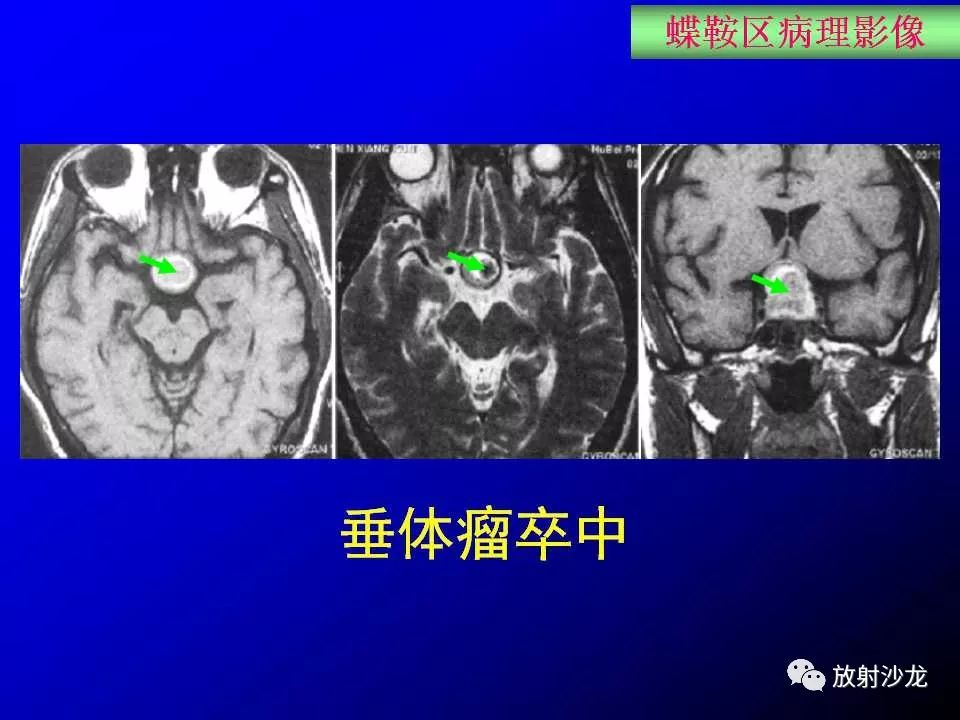 蝶鞍區解剖及疾病的影像解剖