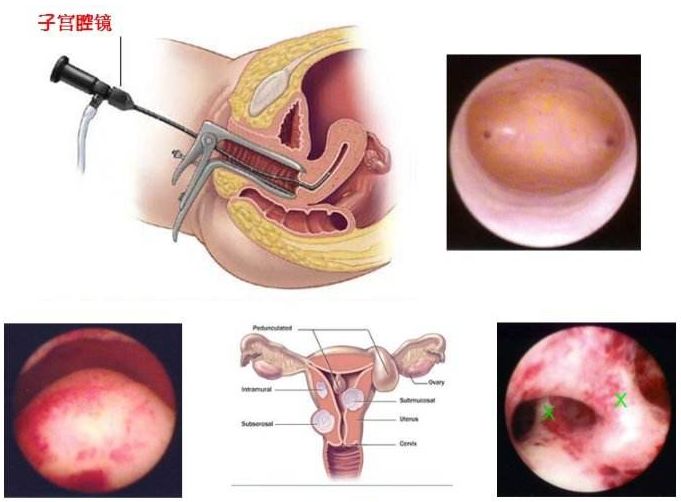 子宫内膜息肉什么鬼怎么治疗