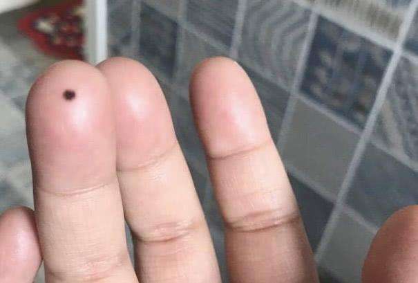 我的手指突然出血了 就像一颗色素痣一样