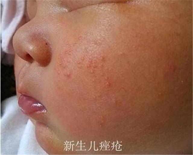 这四种宝宝常见皮肤病,别在傻傻的分不清当成湿疹了