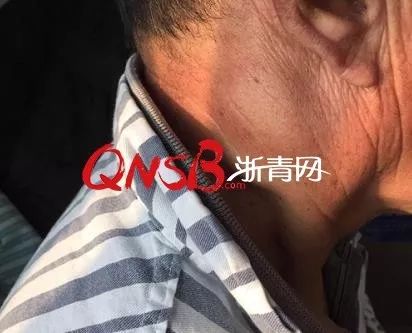 耳朵后面长个小疙瘩不痛也不痒…上医院一查竟是肺癌!