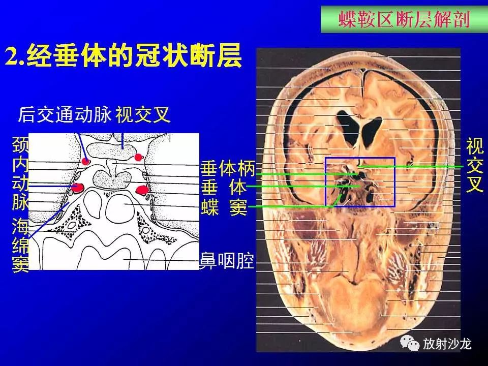 蝶鞍床突解剖图片