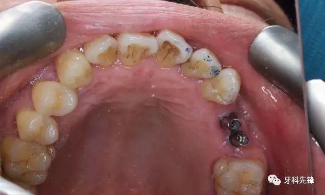 病例两颗种植牙种歪的病例补救