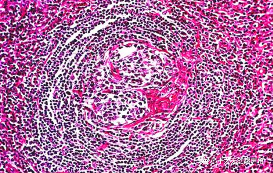 揭秘淋巴結總是令人困惑的存在castlemandisease