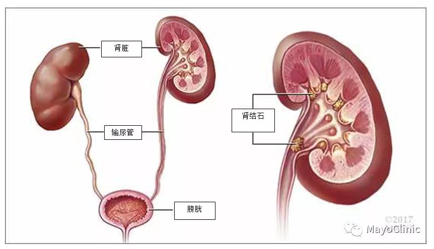 梅奥研究发现:女性肾结石的患病率在上升