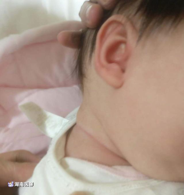 宝宝先天斜颈出生半年内治疗最佳赶紧检查下宝宝脖子