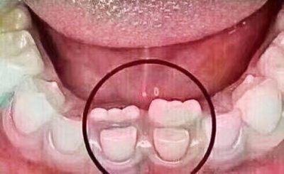 恒牙双排牙恢复图片图片