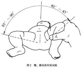 髋关节屈曲外展试验:双髋关节和膝关节各屈曲90°时,正常新生儿及婴儿