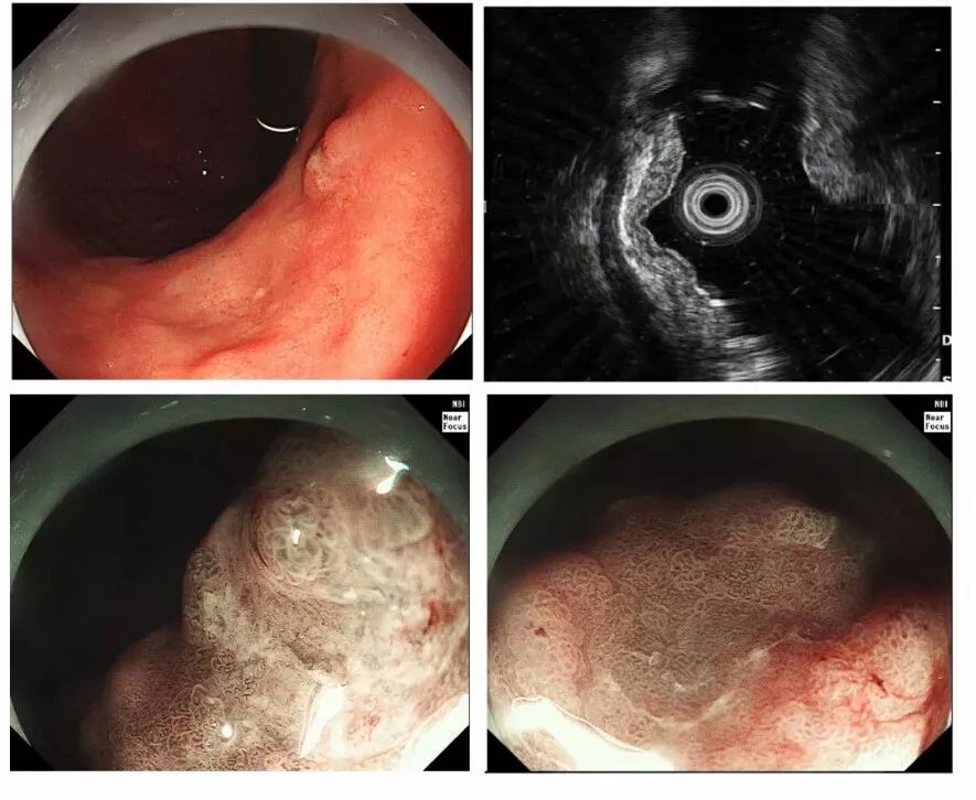 4个精彩病例带你了解早期胃癌有图有真相