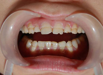 轻症患儿的牙齿表面硬而光滑,但光泽度稍差,牙面上出现不透明的,白垩