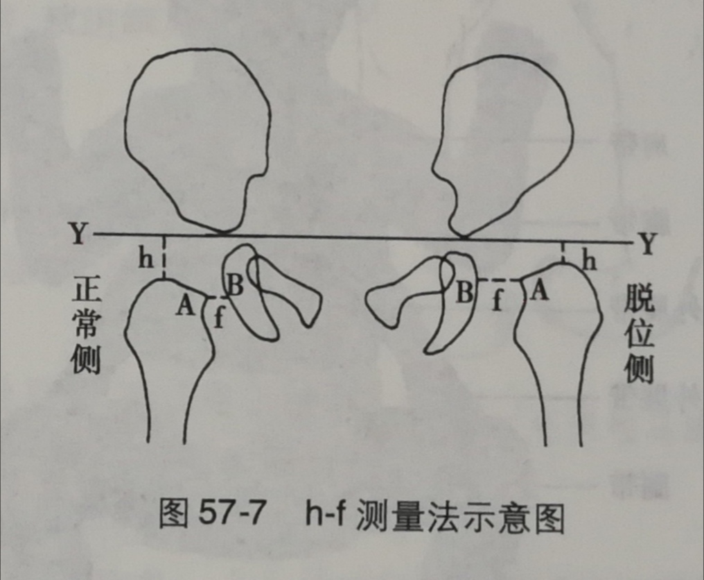 另外,還可觀察到股骨頭骨化中心較鍵側小,患側股骨頸前傾角增大,正位