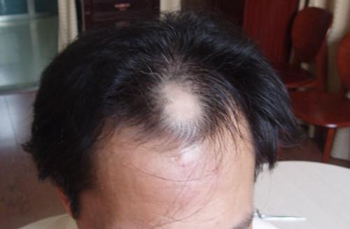 脱发的,出油导致少量掉头发也是正常情况,油脂堵塞了毛孔使其发炎萎缩