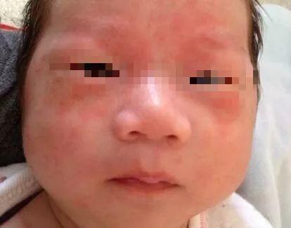 春风一起,怎么娃儿的皮肤就变粗糙了?面部还经常出红疹?