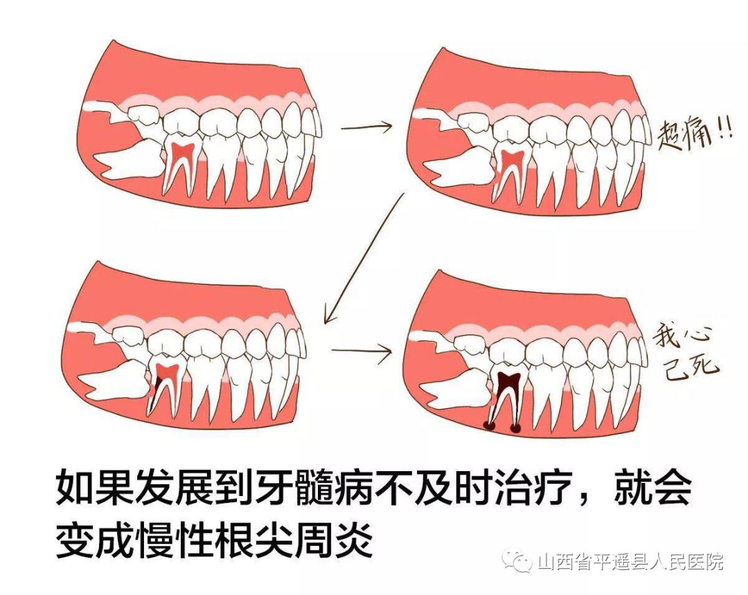 智齿及智齿的危害