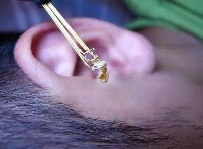 4 小贴士 当耳朵中的耳垢过多或者日久耳垢积成硬块时,会