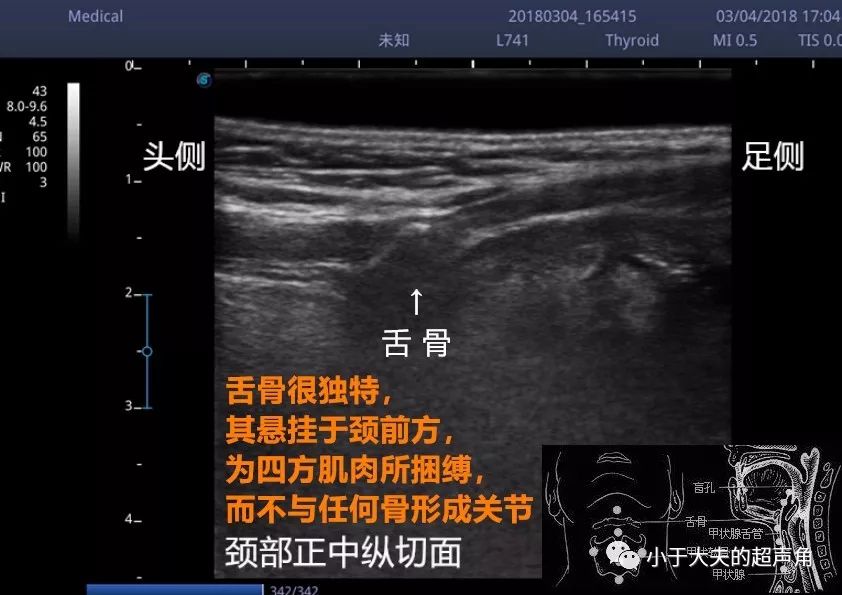 縱切面之舌骨,如圖所示,表現為略傾斜的線樣強回聲,伴聲影.