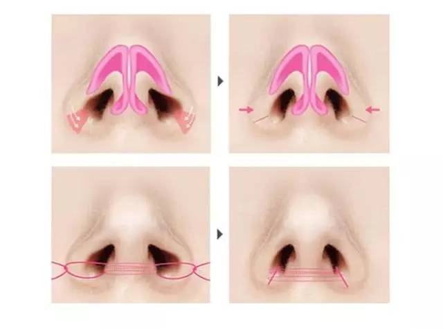 鼻翼缩小的方法有几种图片