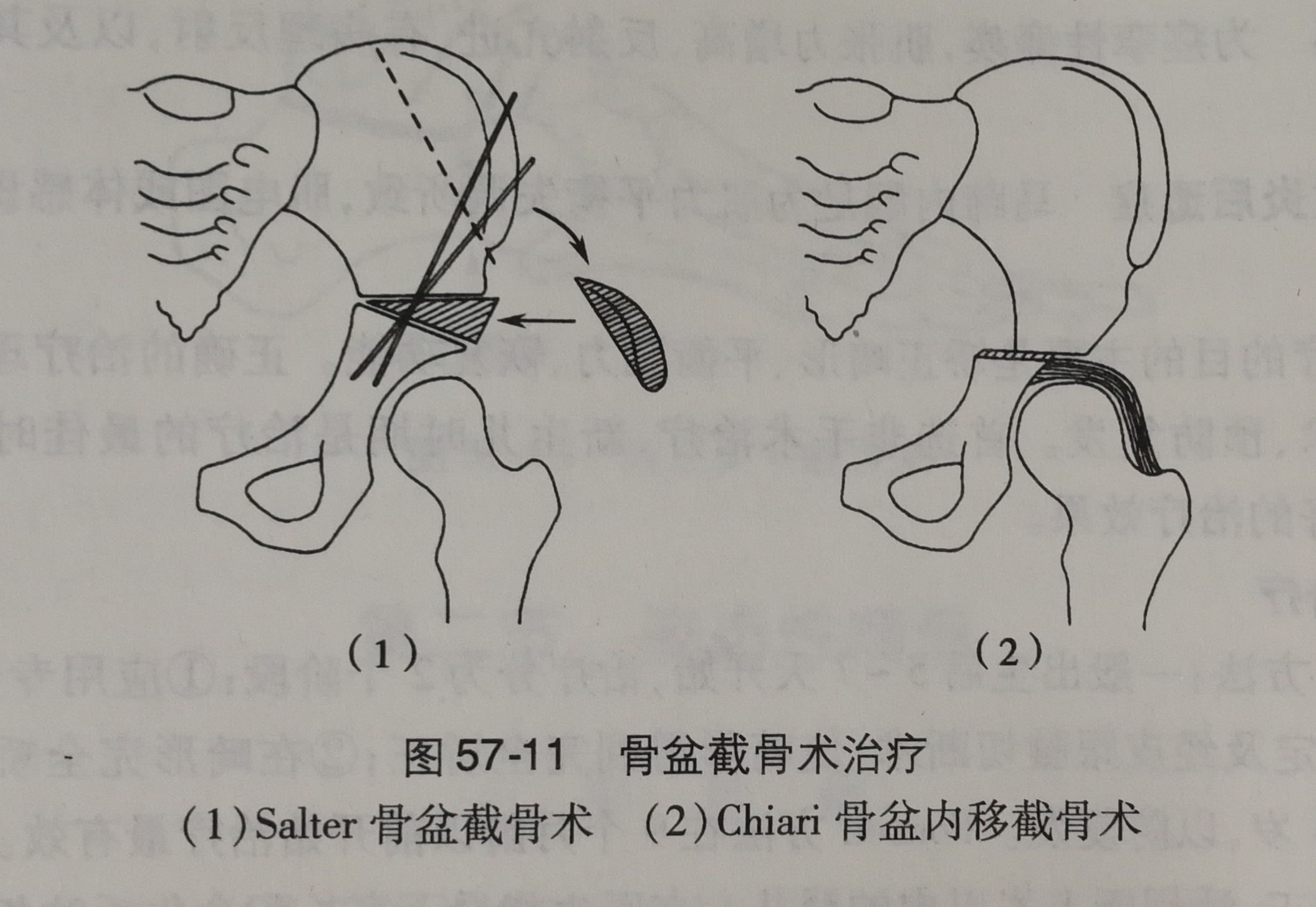 常采用放弃复位的姑息手术,如骨盆内移截骨(chiar)术(见上图右侧图)