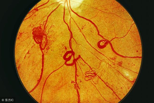 运动性眼外伤:羽毛球拍出的视网膜脱离