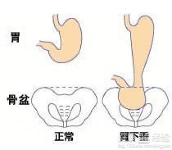 胃下垂图片真实图片