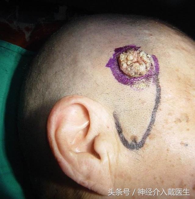头部乳头瘤图片