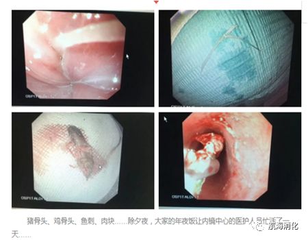 【收藏】魚刺雞骨頭卡在喉嚨口怎麼辦?