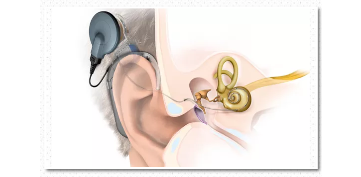 人工耳蜗植入体图片