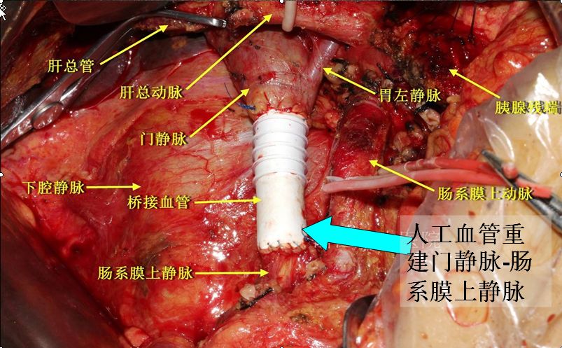 市較早獨立開展胰頭癌根治性手術(胰十二指腸切除術或whipple手術)