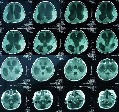 腦核磁軸切面影像顯示腦室內和腦幹周圍嚴重的腦積水