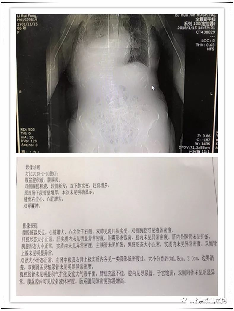 肠梗阻x线报告模板图片