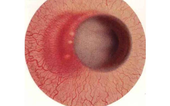 巩膜炎:发病率仅占眼病患者总数的05% 但一旦发病就难于修复!