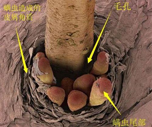 脸摸上去有颗粒毛孔变粗竟藏有一窝螨虫2药方皮肤变光滑平整