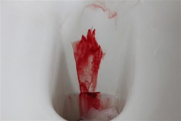 血尿的照片图片