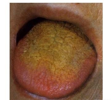 舌苔黄是什么原因？