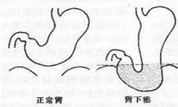 胃下垂的体型图片图片