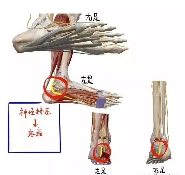 走路脚跟痛?当心"跟痛症"