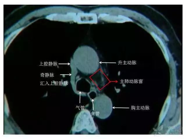注:最后两张彩图是胸腔的血管图,所以看不到颈内静脉和锁骨下静脉汇